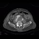 Aortocaval fistula, aneurysm of abdominal aorta, AAA: CT - Computed tomography